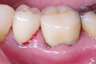 折 歯根 破 歯の破折（はせつ）とは？ 原因・症状・治療＆予防法